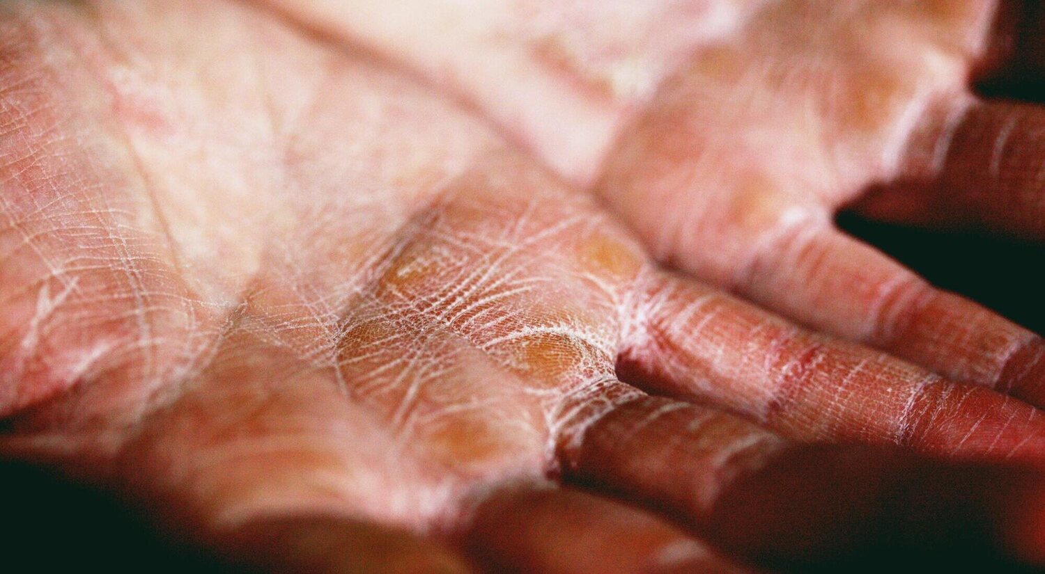 7 consejos para evitar la piel seca en invierno