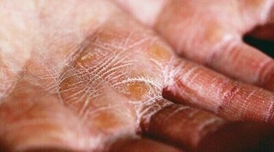 7 consejos para evitar la piel seca en invierno