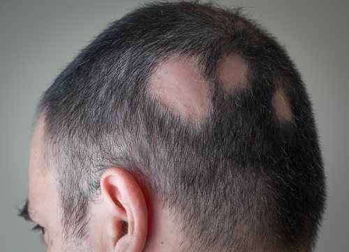 La alopecia areata es de las más complicadas desde el punto de vista estético.